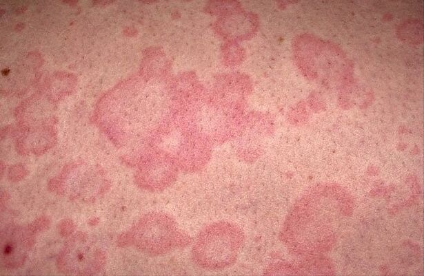 allergia ai parassiti
